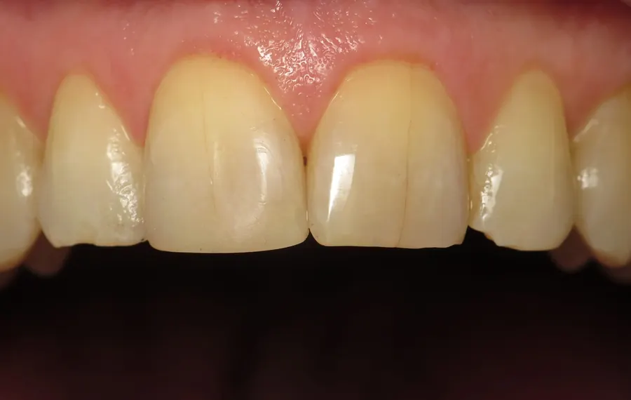 After: the chip rebuilt with tooth-colored bonding.