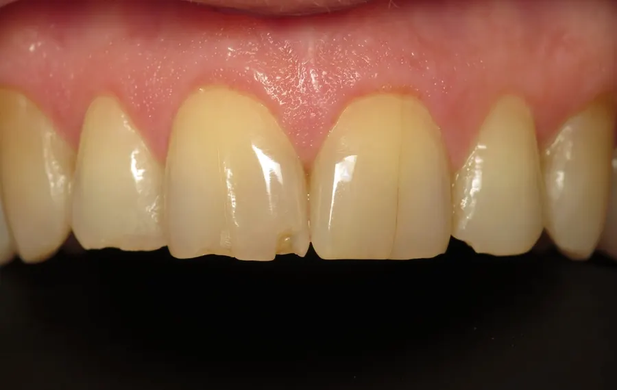 Before: a chipped edge on an upper front tooth.