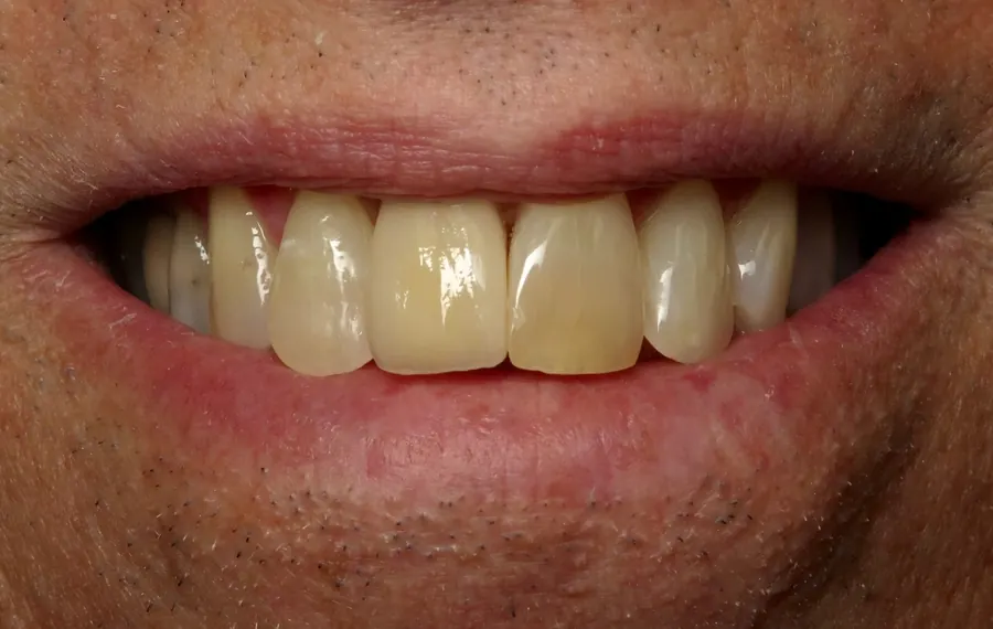 After: the tooth restored with a matching crown.