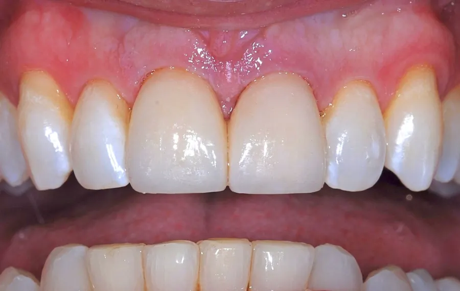 After: the gap between the front teeth closed.