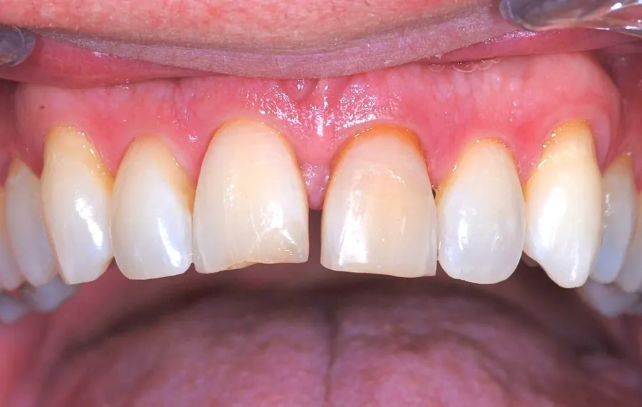 Before: a gap between the upper front teeth.