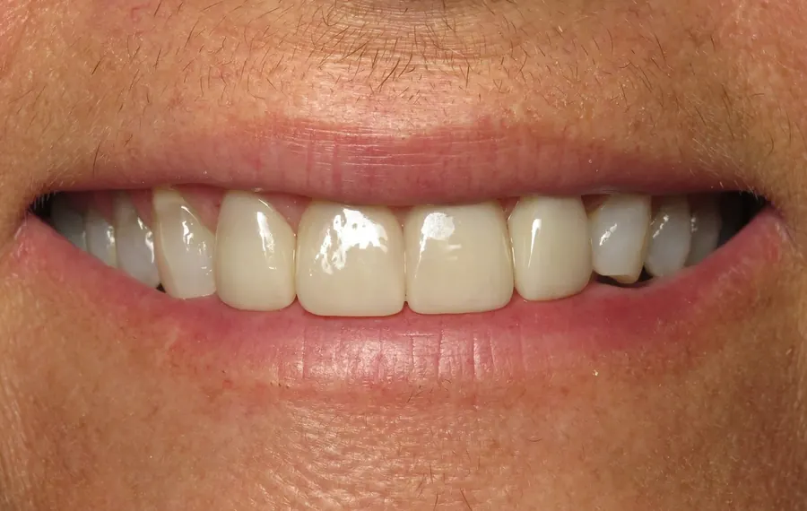 After: veneers and a gum lift with an even smile line.