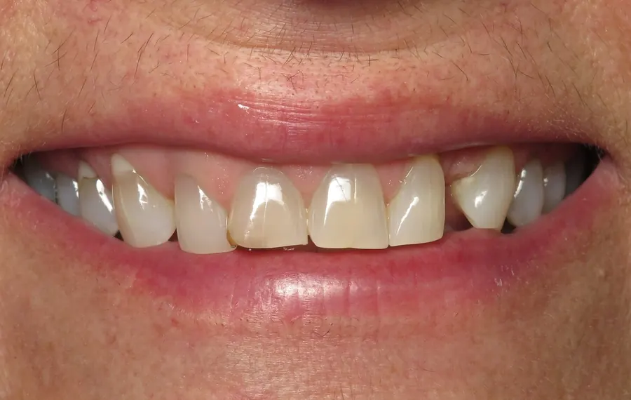 Before: short, uneven upper teeth.
