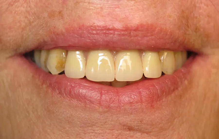 After: a full smile with a partial denture.