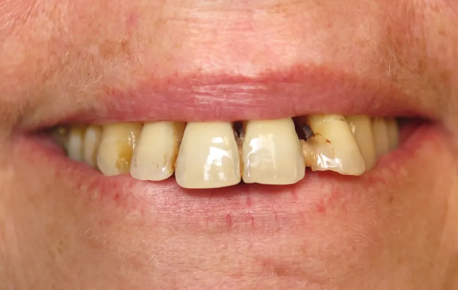 Before: missing and discolored front teeth.
